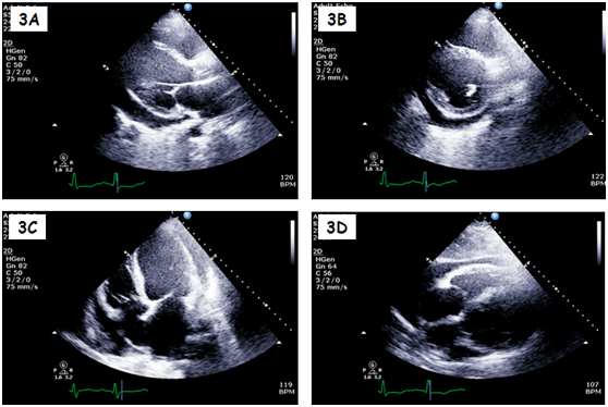 A 49 Year Old Woman With Orthopnea And Moderate Pericardial Effusion