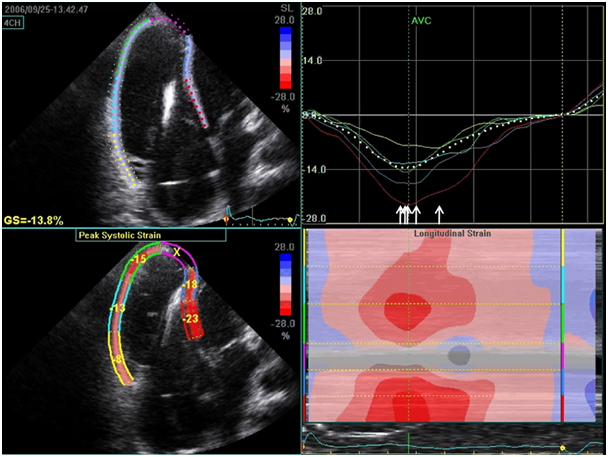 Clinical Applications - Speckle Tracking