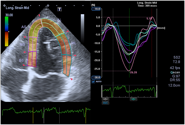 Clinical Applications Speckle Tracking