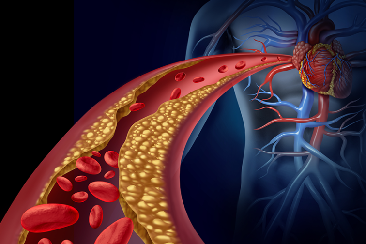 Peripheral arterial and aortic disease