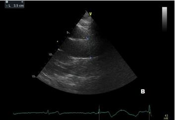 Aortic root dilation in competitive athletes