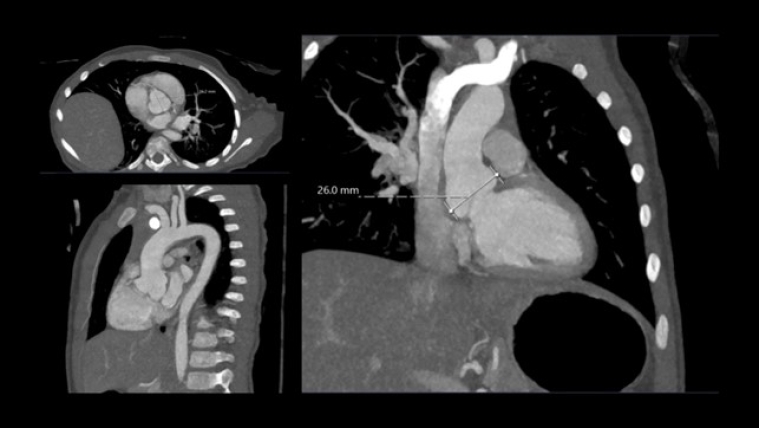 Figure 4. CT scan at 5 y.o. showing aorta dimension.