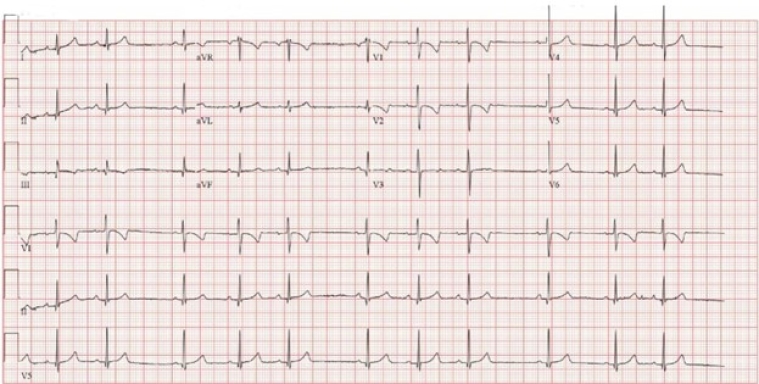 Figure 2. ECG at 12 month old.