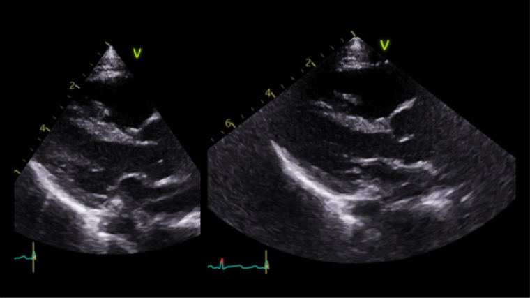 Figure 3. PLAX showing dilation of sinus of Valsalva in systole and diastole.