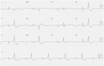 Extra ventricular store systole