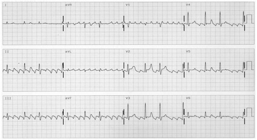 typical atrial flutter and ecg