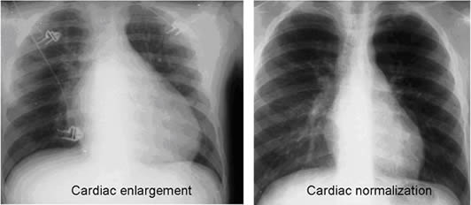 Tachycardia-induced cardiomyopathy