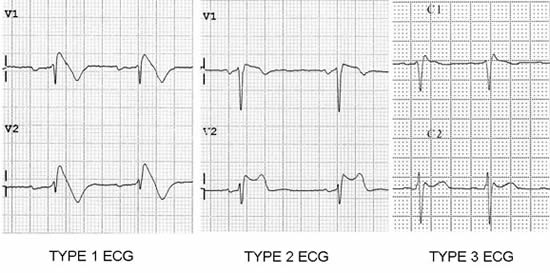 Management Of Patients With A Brugada ECG Pattern