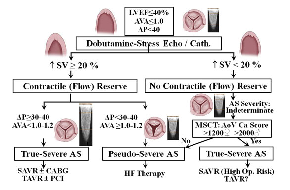 low flow low gradient aortic stenosis        
        <figure class=