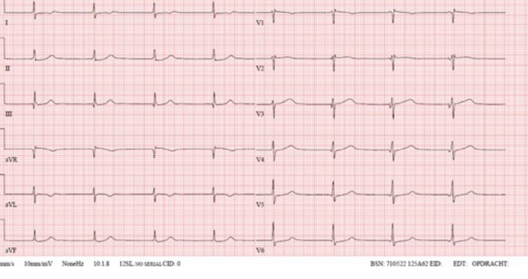 ECG spot the diagnosis Sept 2024.png