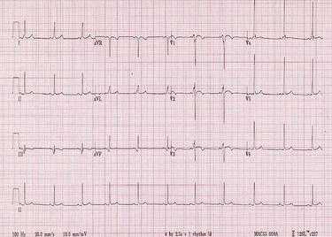 Arrhythmogenic Right Ventricular Cardiomyopathy