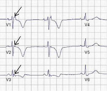 Serial ecg frequency test