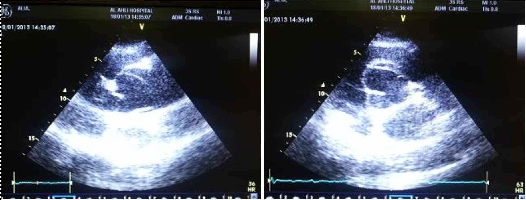 Acute aortic dissection