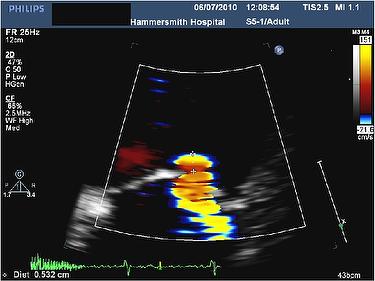 Ischemic mitral regurgitation and mitral clip insertion