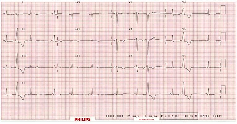 Cardiac arrest in a young dancer