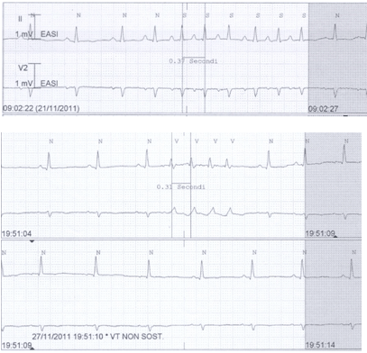 A 71 year old female diabetic patient with recent NSTEMI, normal ...